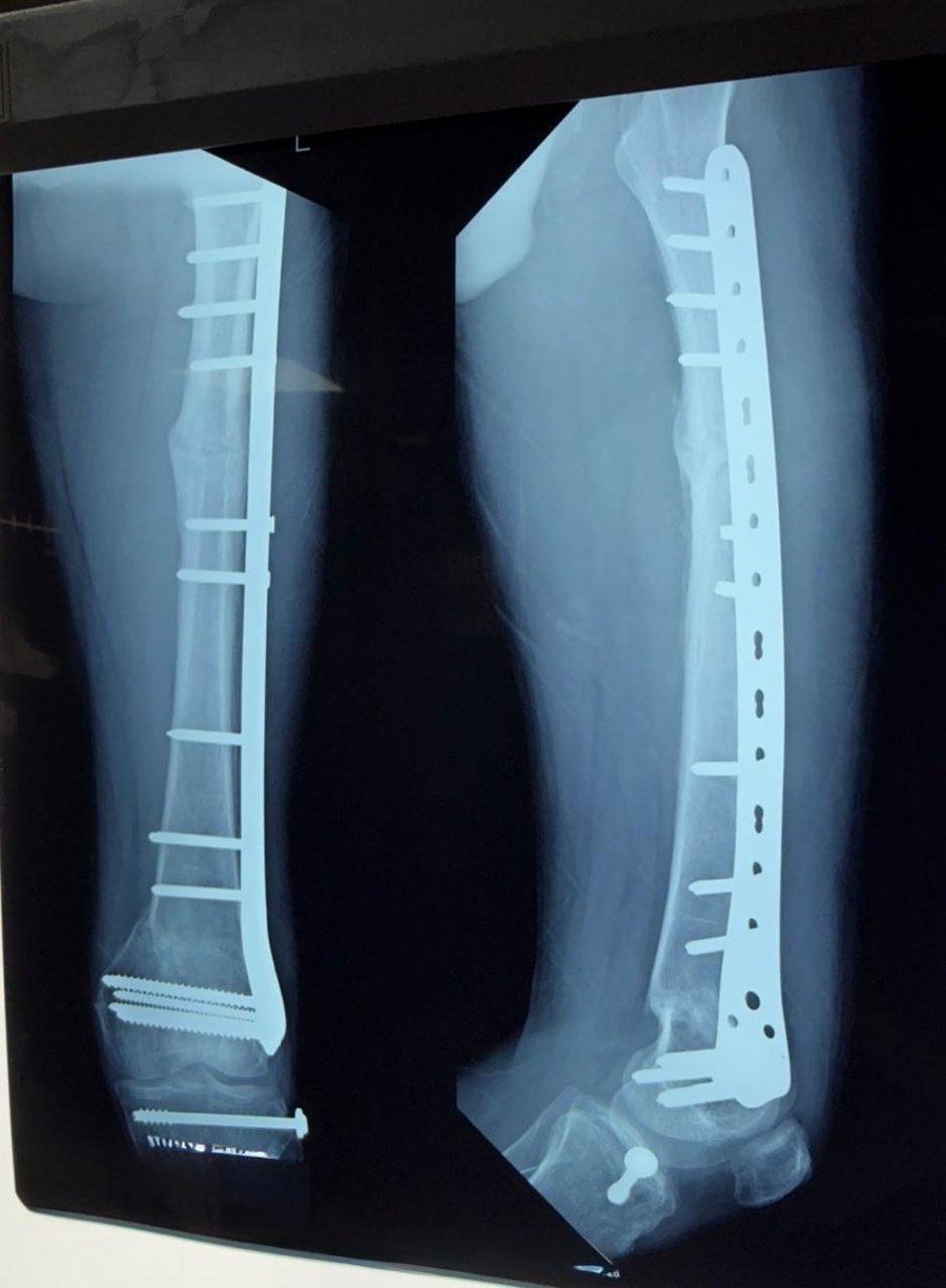Post-operative X-ray showing internal fixation of a long-bone fracture